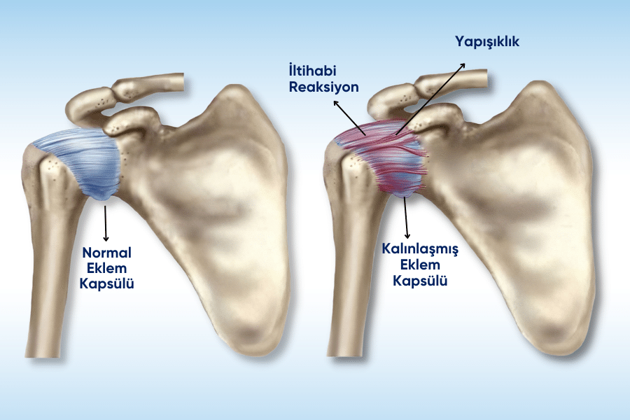 Donuk Omuz Nedir? Belirtileri, Nedenleri ve Fizyoterapi Yaklaşımı
