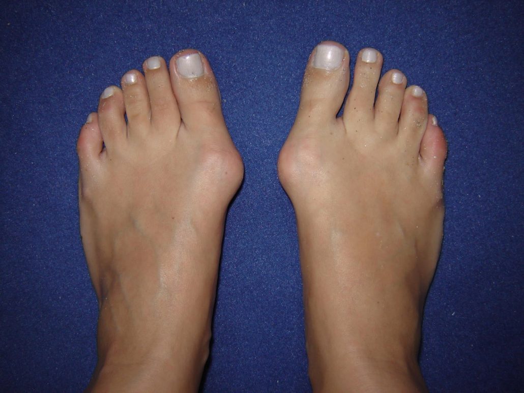 Halluks Valgus Nedir? Manuel Terapi ve Fizyoterapi ile Yaklaşım