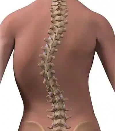 Skolyoz Nedir? Schroth Egzersizleri ve Rehabilitasyonu