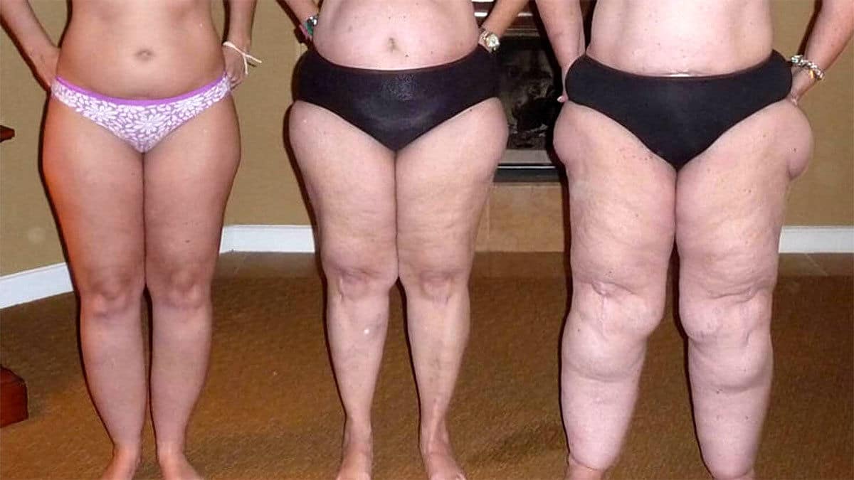 Lenfödem Nedir? Belirtileri ve Fizyoterapi Yaklaşımı