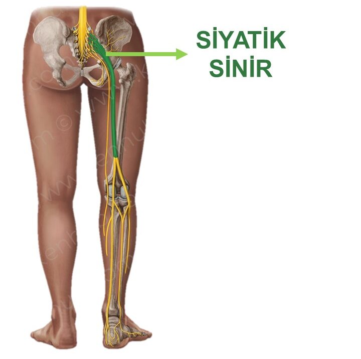 Siyatik Nedir? Bacağa Vuran Ağrının Nedenleri ve Fizyoterapi