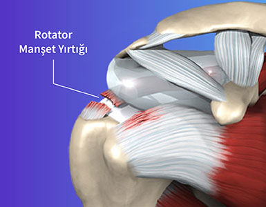 Rotator Manşet Yırtığı Ameliyatsız İyileşir mi?