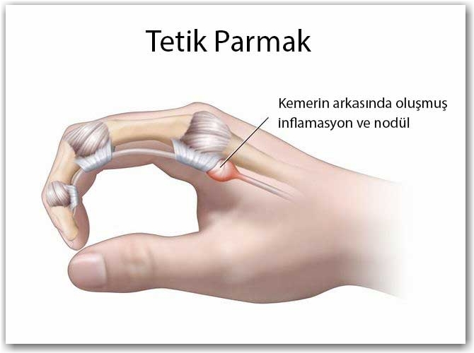 Tetik Parmak: Parmak Neden Takılır veya Kilitlenir?